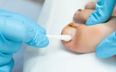 Fungal Nail Test Kits